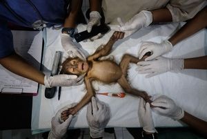 A baby orangutan lies on a gurney with her limbs stretched out being prepped for surgery. She is surrounded by several pairs of hands wearing medical gloves and various medical devices.