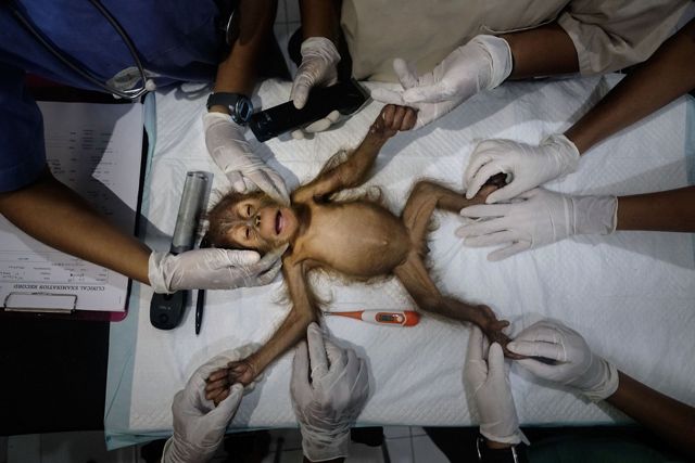 A baby orangutan lies on a gurney with her limbs stretched out being prepped for surgery. She is surrounded by several pairs of hands wearing medical gloves and various medical devices.